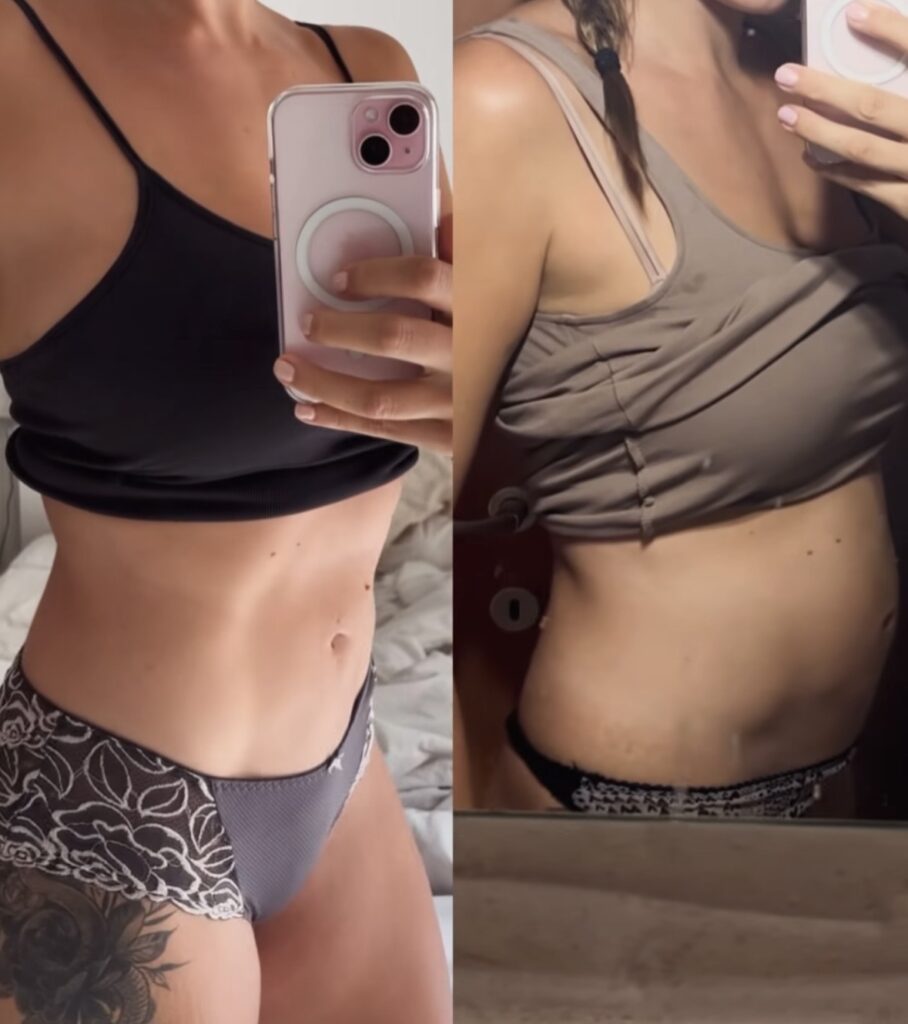 Endometriosis swelling aka endobelly