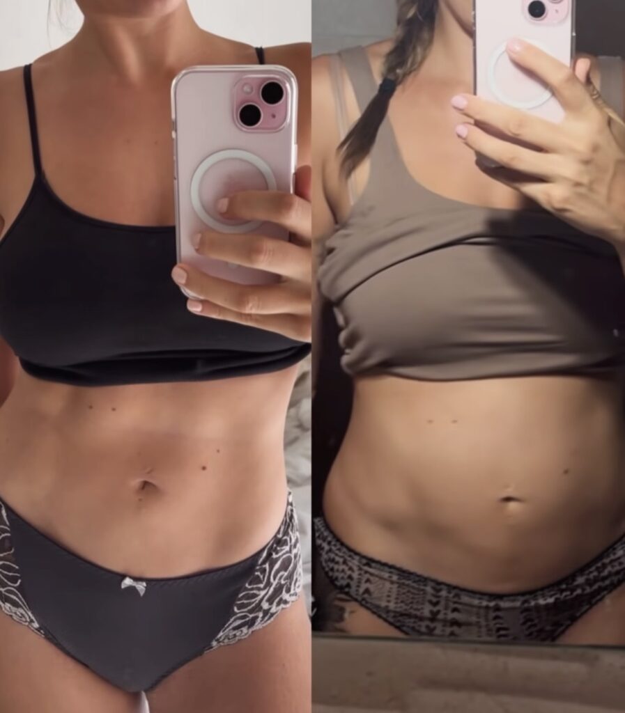 Endometriosis swelling aka endobelly